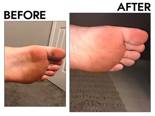 Baby Foot Exfoliation Foot Peel before and after
