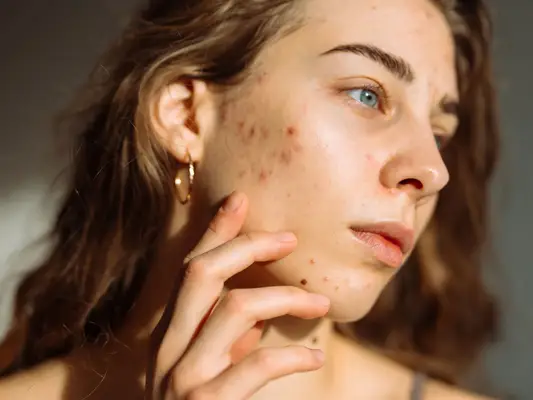 Close up of a woman with acne touching her face