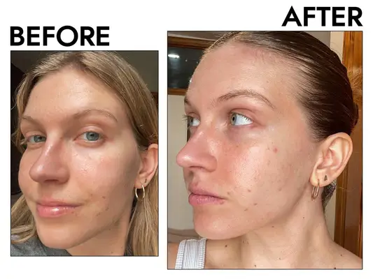 Amazon La Roche-Posay Effaclar Duo