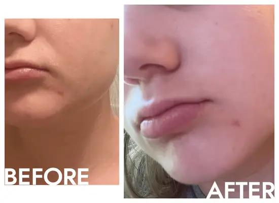 bella before and after using the Sofie Pavitt Acne Mask