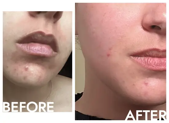 Star before and after using the Sofie Pavitt face mask