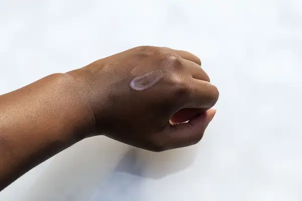 Dollop of acne scar treatment applied to back of hand