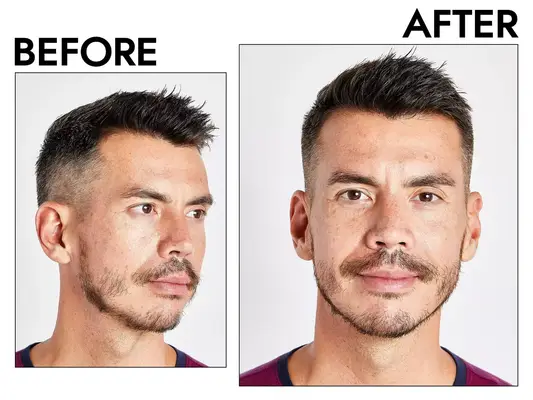 Photos of person’s face before and after using The Ordinary Caffeine 5% + ECGC Depuffing Eye Serum