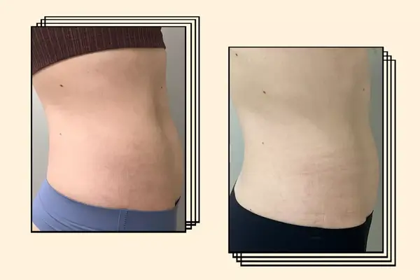 Before and after a TruSculpt ID session on a woman