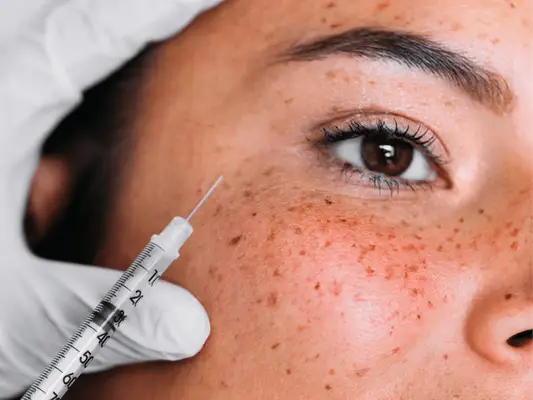 Wstrzyknięcia fibrynowe bogate w płytki (PRF): korzyści, opieka i wyniki