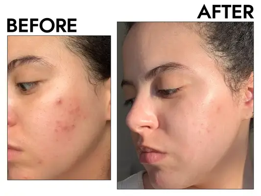 woman with acne before and after photo