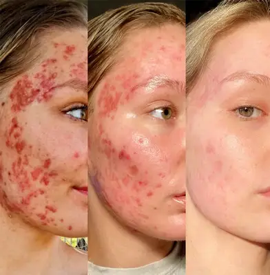 accutane acne treatment progress timeline