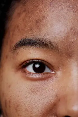 closeup of face with acne scarring