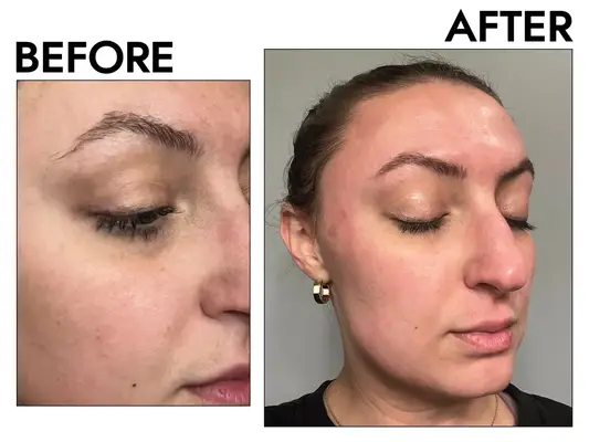 BeautyBio GloPRO Facial Microneedling Tool