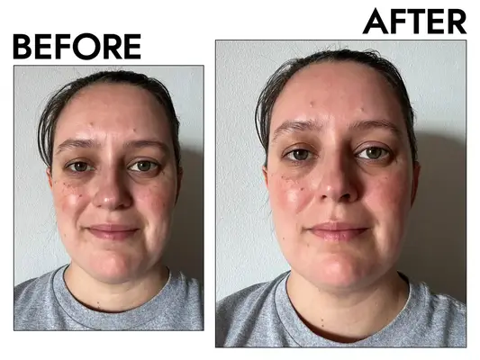 Amazon Angel Kiss 4 in 1 Titanium Microneedling Roller Kit