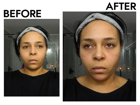 Amazon Prosper Beauty 6 Piece Microneedle Derma Roller Kit