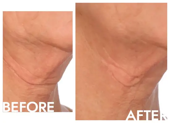 before and after photo of wrinkle taping on a woman