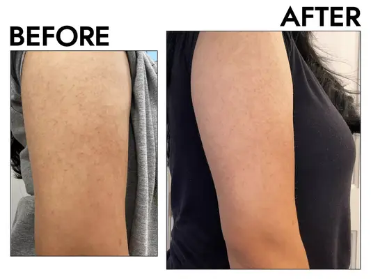 Amazon AmLactin KP Bumps Be Gone Hydrating Cream