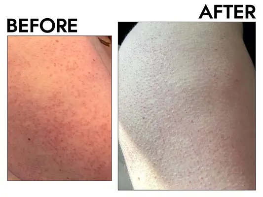 Vanicream Moisturizing Skin Cream before after
