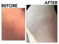 Vanicream Moisturizing Skin Cream before after