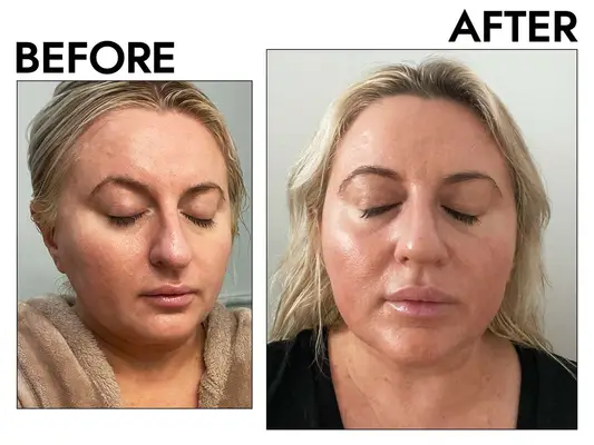 Photos of person’s face before and after using Paula