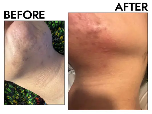 A before and after of using the braun ipl on the chin