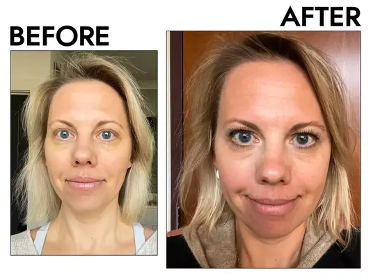 Photos of person’s face before and after using iUNIK Calendula Complete Deep Vegan Cleansing Oil