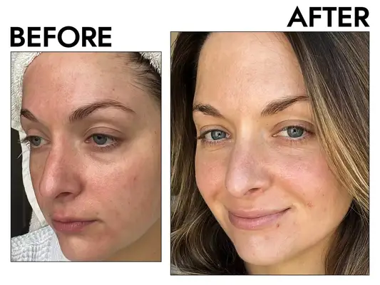 Photos of person’s face before and after using Tatcha Camellia Cleansing Oil