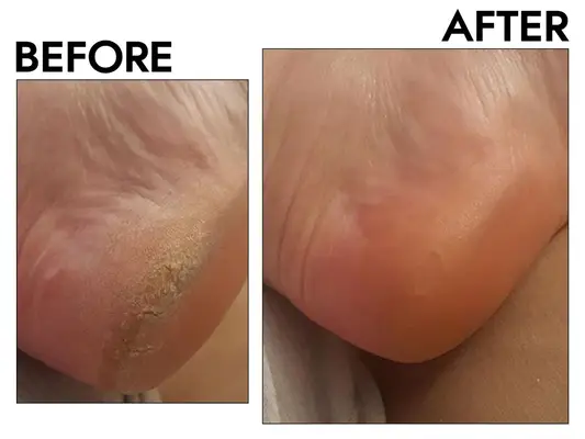 Photos of person’s heel before and after using Rikans Foot File and Callus Remover