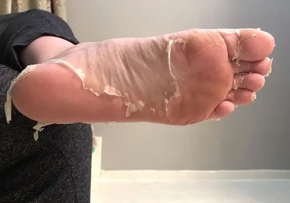 photo of a person using the Baby Foot Exfoliating Foot Peel