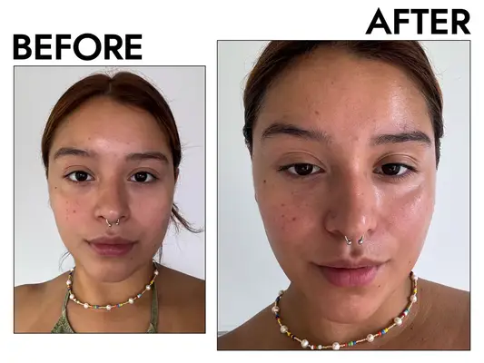 Before and after photos showing the effects of using Vanicream Daily Facial Moisturizer