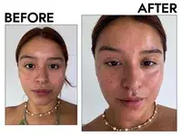 Before and after photos showing the effects of using Vanicream Daily Facial Moisturizer