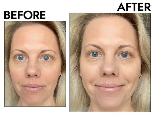 Before and after photos showing the effect of using Glossier Perfecting Skin Tint for Dewy Sheer Coverage