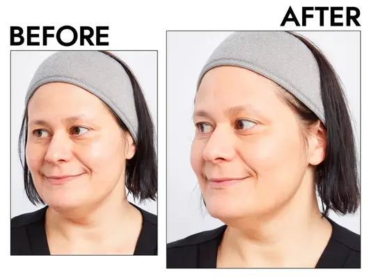 Photos of person’s face before and after using Almay Make Myself Clear Clear Complexion Makeup