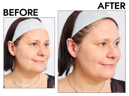 Photos of person’s face before and after using Revlon ColorStay Makeup for Normal/Dry Skin SPF 20